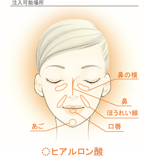 ヒアルロン酸注入部位